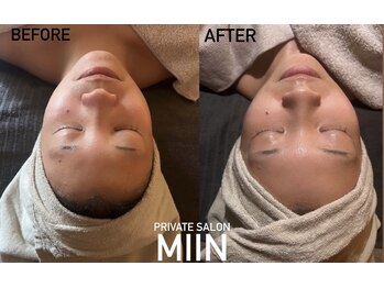 ミイン(miin)/ララピールのみ★2回目の施術