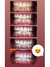 エクシア ホワイトニング 鶴岡店/ビフォーアフター