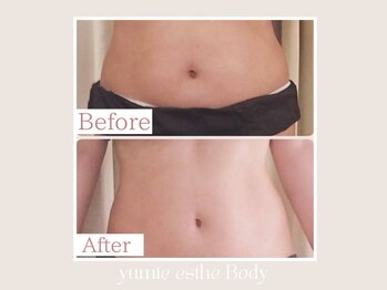 トータルビューティー ゆみえエステ(Total Beauty)/痩身