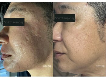 ソルテシュガーリング(SORTE sugaring)/メンズ肌管理