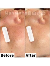 マハロハ 自由が丘(Mahaloha)/【シミケア・肌荒れ改善施術】
