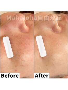 マハロハ 自由が丘(Mahaloha)/【シミケア・肌荒れ改善施術】