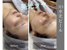 グロウ(glow.)/施術直後のBefore/After