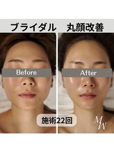 ミピマム/史上最高小顔ブライダルコルギ