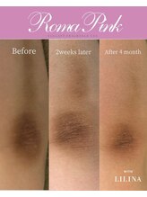 ウィズリリナ 新横浜(with Lilina.)/ローマピンク　症例　肘　ひじ