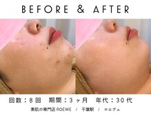 ロエヴェ(ROEWE)/ニキビ改善・毛穴ケア・肌質改善