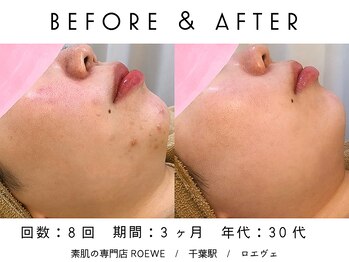 ロエヴェ(ROEWE)/ニキビ改善・毛穴ケア・肌質改善