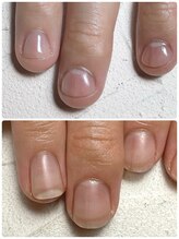 スマイルニコ(smile nico)/男性の深爪矯正