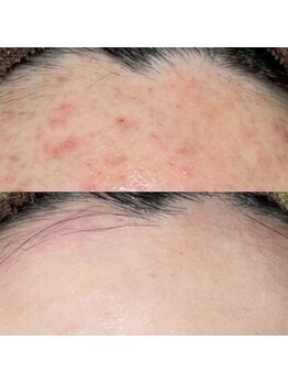 ソワ 吉塚店(soi)/繰り返さないニキビケア☆