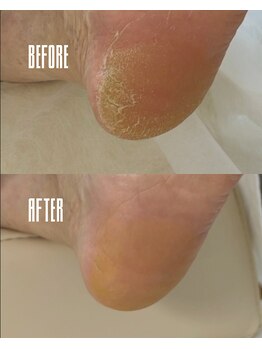 おん/カチカチ踵