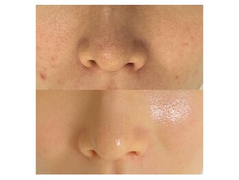 シューラディアント(ShuRadiant)の写真/毛穴悩みに自信あり【黒ずみ/開き/数種類の最先端技術からお悩み別の毛穴を改善！】ニキビケアや凹凸にも◎