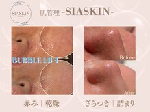 シアスキン(SIASKIN)