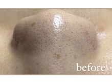 リリーブー 池袋(Lilyboo)/毛穴洗浄ハイドラフェイシャル