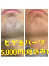 リアンジュ/ヒゲ脱毛の経過