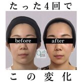 小顔矯正専門サロン キュープ 茨城つくば店(Qpu)