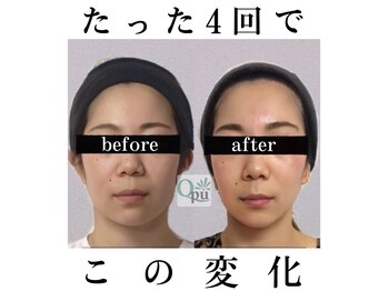小顔矯正専門サロン キュープ 茨城つくば店(Qpu)