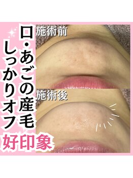 ホワイトワックス 名古屋金山店(WHITE WAX)/口・あご周りの産毛確実に除去！