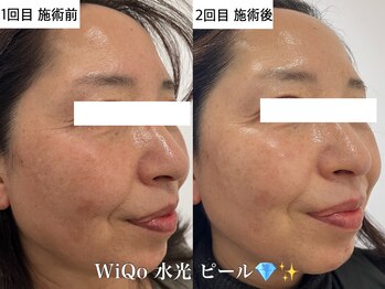 ウィ アネラ(U'i Anela)/WiQo 水光ピール