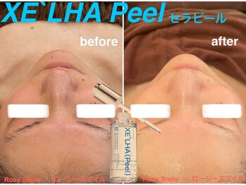 ロージースマイル(Rosy smile)/【韓国肌管理★ セラピール 】