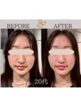 チョコバリ 中目黒店(chocobari)/小顔×リフトアップ(美容鍼)20代