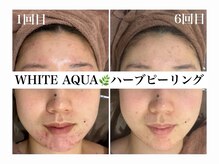 ホワイトアクア 加古川店(WHITE AQUA)/ハーブピーリング/毛穴/加古川
