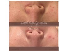 ルアナ 柏本店(LUANA)の雰囲気（ニキビ、黒ずみ、毛穴、肌荒れに｜ハーブピーリング柏）