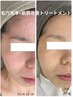 【シミ・毛穴】肌を育てるトリートメント(毛穴洗浄付)お試し体験 通常¥16,500