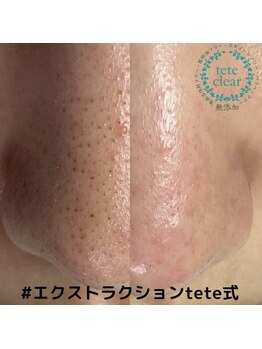 プライベートサロン コットン(COTTON)/施術メニュー（毛穴）