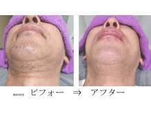 ツインズ/メンズ髭脱毛ビフォーアフター