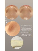 クレヴィー(Creviy)/韓国式3D毛穴洗浄＋ハーブ＋脱毛