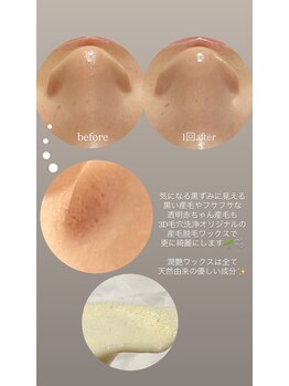 クレヴィー(Creviy)/韓国式3D毛穴洗浄+ハーブ+脱毛