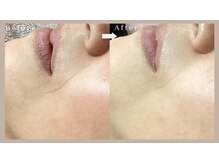 ネリネ(Nerine)/首～顔～頭トリプルリフト