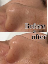 トータルビューティー ミミ(Total Beauty mimi)/毛穴の黒ずみ・ざらつき・開き