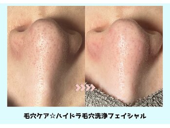 バベルトータルビューティー 北堀江店(Babel Total Beauty)/ハイドラ毛穴洗浄コース￥3000
