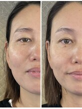 エム ビューティー(M Beauty)/セルラム　ビフォア＆アフター