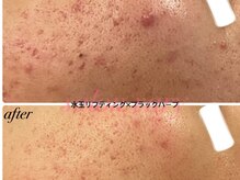 サロンヴェアリー 広尾(salon vary)/水玉＋ブラックハーブピーリング