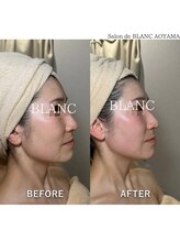 サロン ド ブラン アオヤマ(Salon de BLANC AOYAMA)/1番人気コース！before/after