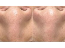 ラクーン(RACCOON)/