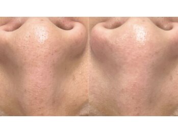 ラクーン(RACCOON)/