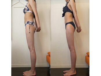 レナトゥス 銀座(Renatus)/BeforeAfter【美脚/東京/銀座】