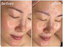 ホワイトアクア 天王寺本店(WHITE AQUA)/ララピールでツヤ肌★大阪天王寺