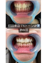アイブロウ33 薬院店/ホワイトニングビフォーアフター