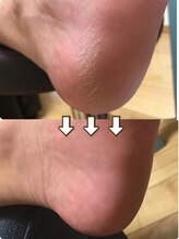 ビアンカ 沖縄おもろまち店(Bianca)/角質ケア￥2750～