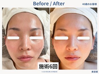 恵比寿ループ鍼灸院(LOOP)/お顔の左右差の改善