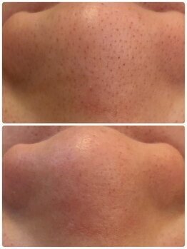 ユフラ(Juhla)/韓国式3D毛穴