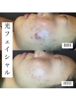 アース コアフュールボーテ 上越店(EARTH coiffure beaute)/光フェイシャル
