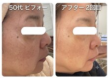 オリーブ(Olive)の雰囲気（50代　頬の赤みが落ち着き、毛穴も引締まり／小顔　毛穴ケア）