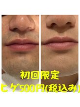 リアンジュ/ヒゲ脱毛の経過