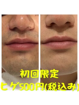 リアンジュ/ヒゲ脱毛の経過