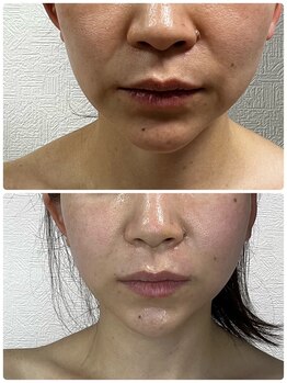 ソフィーム/老化は口回りにビフォーアフター